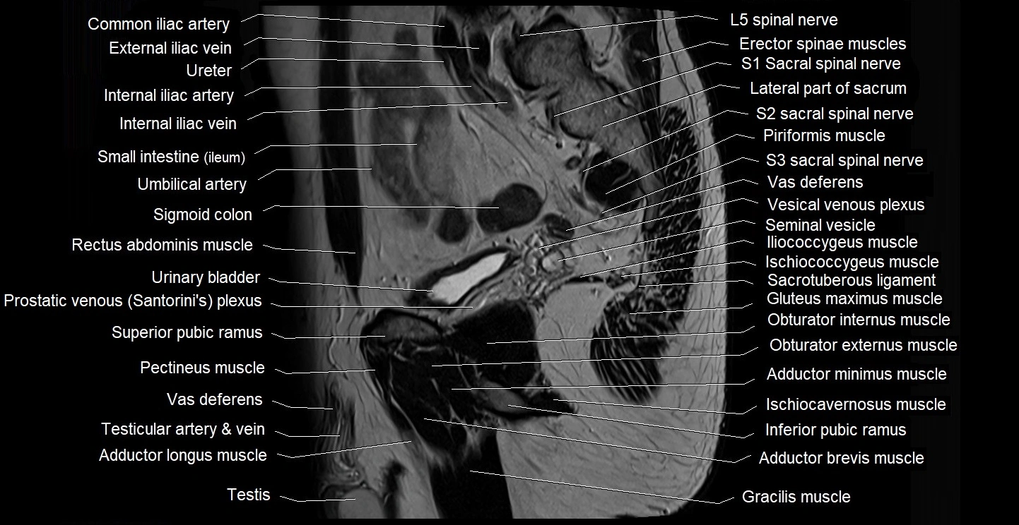 male pelvis sagittal cross sectional anatomy 3T mri image 16.webp
